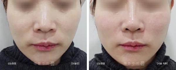 하이코+실리프팅