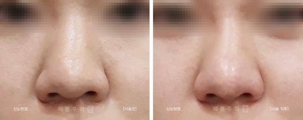 하이코+바비코+코필러