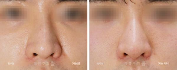 눈밑필러+미주코