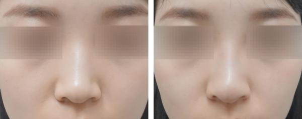 홍대점_바비코(코끝),수입필러